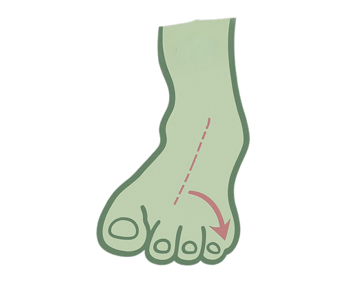 Overpronation